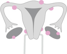 endometrios Fertilitetsråd.se